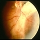 Toxocariasis